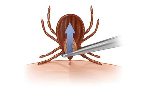tick removal in chennai